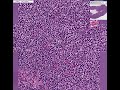 Histopathology Lymph node--Chronic lymphocytic leukemia - sm