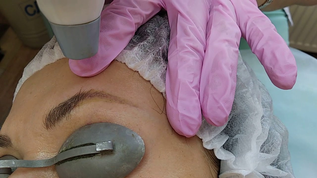 Лазерное удаление татуажа