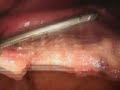 Tube Gastrectomy
