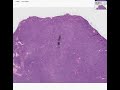 Histopathology Lymph node--Lymphoplasmacytic lymphoma