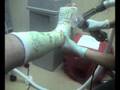 brandon get's his cast removed