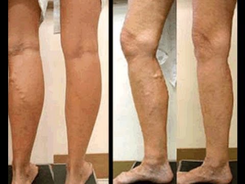 how to eliminate veins