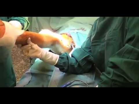 safenectomia -