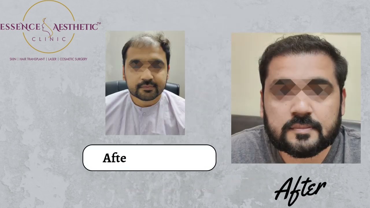 100% result in hair transplant in Vadodara.#hairlosssolution  #hairtransplant  #hairtransplantclinic