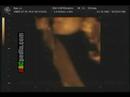 Ecografia 4D