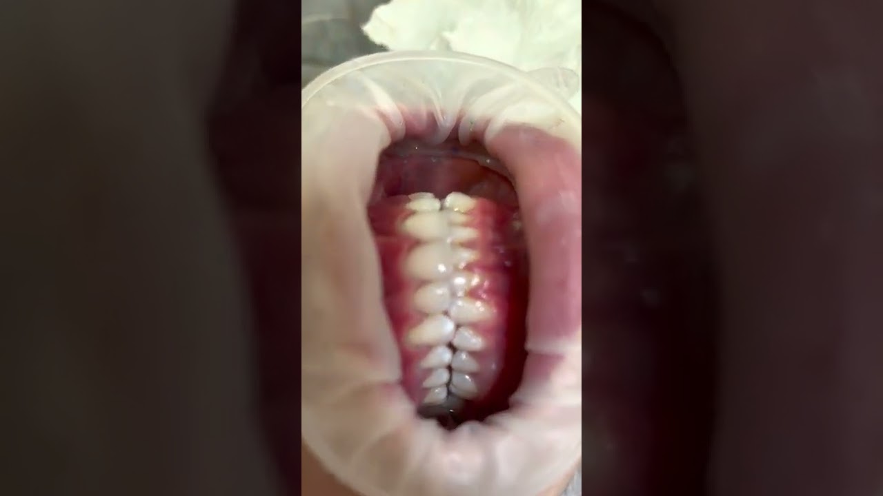 Much Drilling We Would Expect Before an Ultra Thin Veneer is Placed