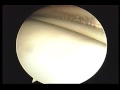 Meniscus Correction On The Medial Side Meniscus Correction On The Medial Side