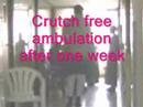 Oxford partial Knee replacement abroad in India