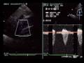 Severe Coarctation of the Aorta