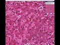 Histopathology Liver--Hemochromatosis