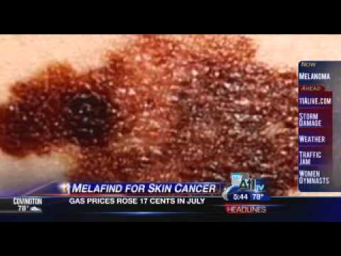 Dr. Mark Knautz talks about MelaFind on NBC 11
