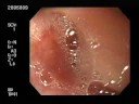 Insertion of EGD (2) Insertion of EGD (2)