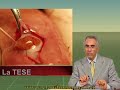 Azoospermia - Assenza di spermatozoi nel liquido seminale