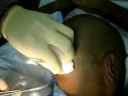 sebaceous cyst removal