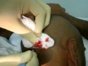 sebaceous cyst removal sebaceous cyst removal