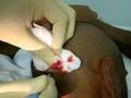 videos de sebaceous cyst removal