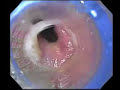 This is a videoendocsopy clip performed and narrated by Dr. Joe Galati of Liver Specialists of Texas, located in Houston, Texas. This video demonstrates esophageal varicies caused by cirrhosis and portal hypertension, and the endoscopic banding of them.