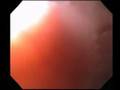 Band Ligation of Esophageal Varicies