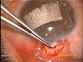 Trabeculectomy Left Eye