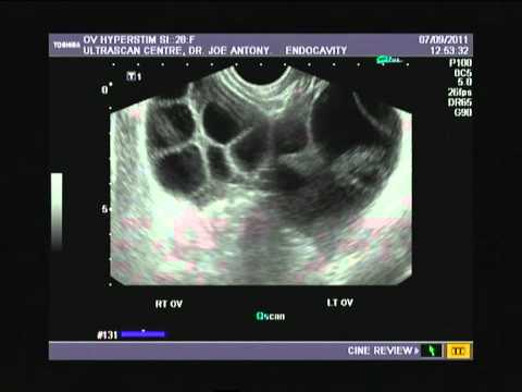 how to cure ohss