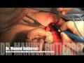 Dr. Manuel Gutierrez Brest reconstruction latisimus dorsis