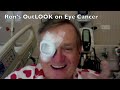 Ron's Out LQQK on Eye Cancer Day 1 after Plaque Radiation MSKCC Day 2 of 4