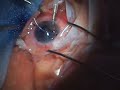 DSEK Suture-Pull Technique DSEK Suture-Pull Technique