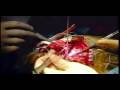 Cirurgia para tumor cerebral (HD) Cirurgia para tumor cerebral (HD)