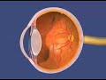 Retinopathy of Prematurity (ROP) Retinopathy of Prematurity