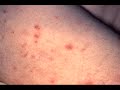 Gary Messer of the Knox County Health Department explains what syphilis is and how the disease presents itself.