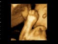 3d-ultrasonografia-braco-feto-ultra-sonografia
