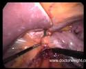 Tight sleeve gastrectomy for morbid obesity