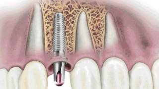 Implantes