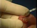 Salivary gland mucocele