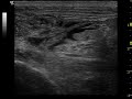 US guided Sciatic nerve block US guided Sciatic nerve block