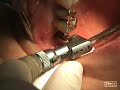 Clinical surgical movie