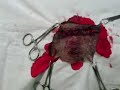 Ablaci�n de tumor de piel