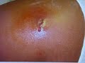 mrsa facts   fiction
