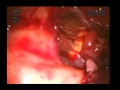 Bypass gástrico endoscopía transqx. #1