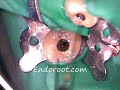 Irrigaci�n ultras�nica en endodoncia