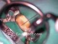 Irrigación ultrasónica en endodoncia
