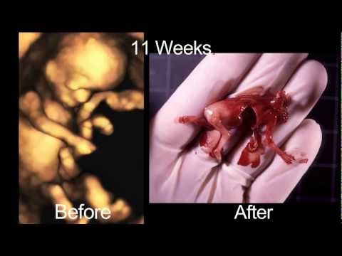 how to self abort at 20 weeks