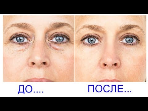 Темные круги под глазами убрать в домашних условиях Темные круги под глазами убрать в домашних условиях