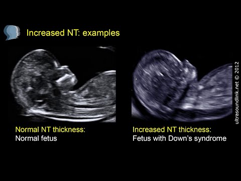 how to measure nt in ultrasound