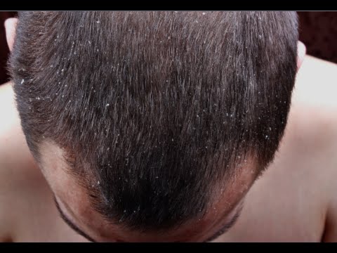 how to cure excessive dandruff