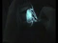 Mesenteric Artiogram Mesenteric Artiogram