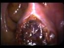 Embarazo tubarico en mujer joven con paridad insatisfecha, se realiza ordeñamiento de latrompa paraconservar su fertilidad. hsotomayori@gmail.com