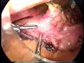 Stomach Stapling - DOCS