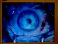 Inter-Vision Ooglaseren Inter-Vision Ooglaseren