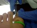 Ingrown Toe Nail Sugery